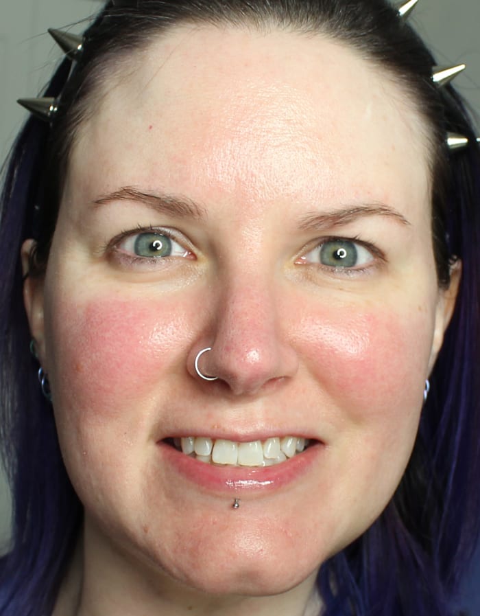Redness from rosacea