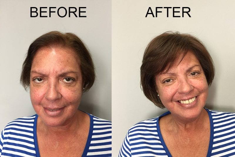 Before and After with Invisablend