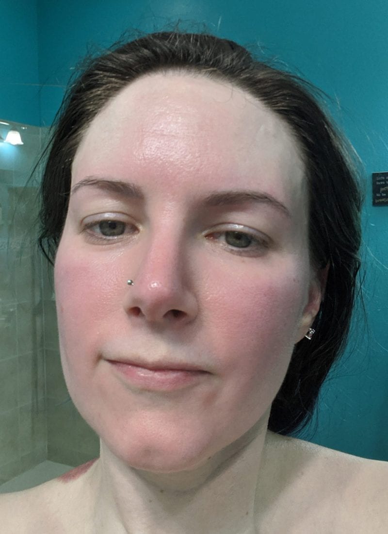 What Rosacea Looks Like